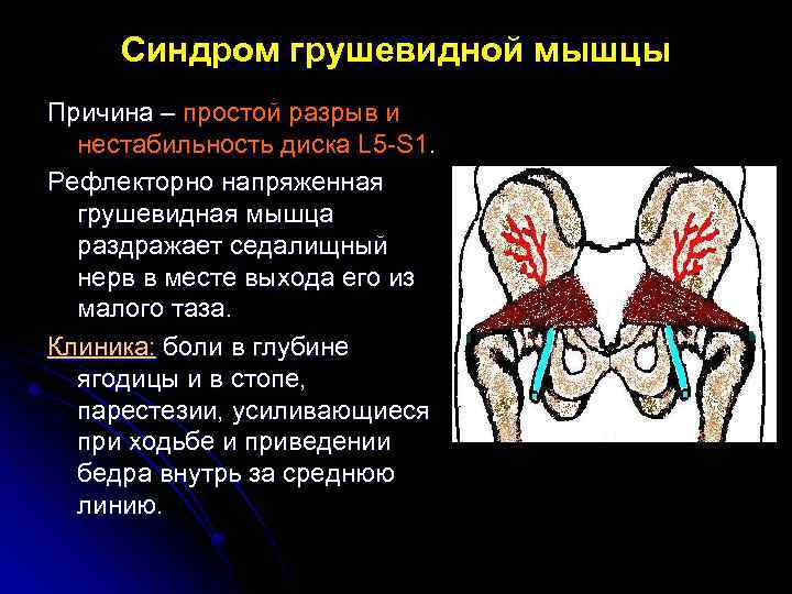 Синдром грушевидной мышцы Причина – простой разрыв и нестабильность диска L 5 -S 1.