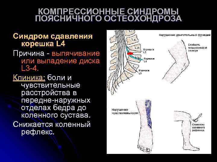 КОМПРЕССИОННЫЕ СИНДРОМЫ ПОЯСНИЧНОГО ОСТЕОХОНДРОЗА Синдром сдавления корешка L 4 Причина - выпячивание или выпадение