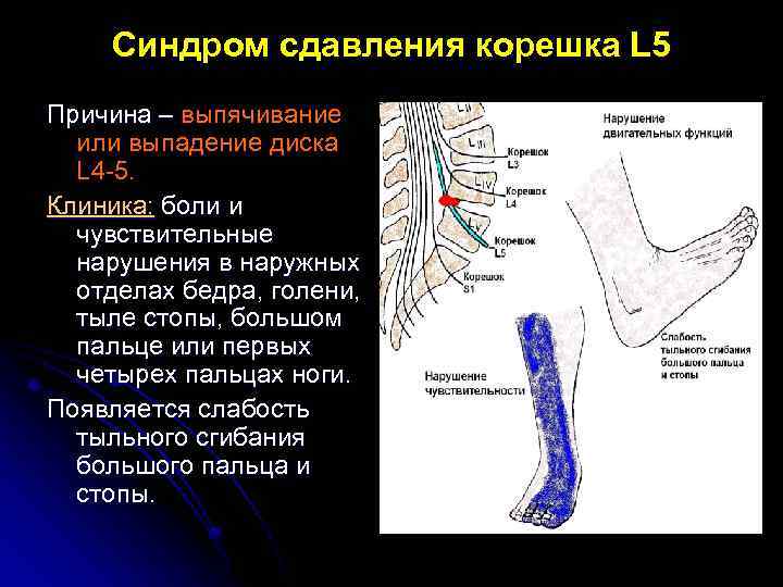 Синдром сдавления корешка L 5 Причина – выпячивание или выпадение диска L 4 -5.