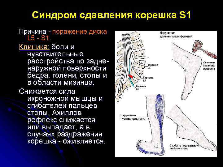 Синдром сдавления корешка S 1 Причина - поражение диска L 5 - S 1.