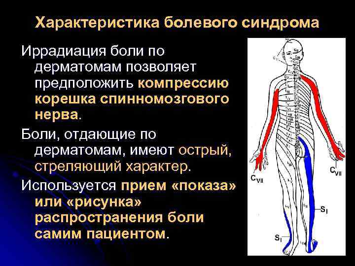 Характеристика болевого синдрома Иррадиация боли по дерматомам позволяет предположить компрессию корешка спинномозгового нерва. Боли,