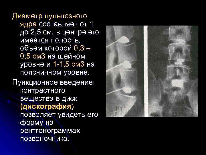 Диаметр пульпозного ядра составляет от 1 до 2, 5 см, в центре его имеется