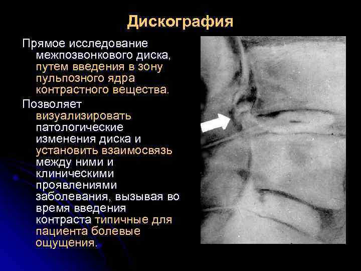 Дискография Прямое исследование межпозвонкового диска, путем введения в зону пульпозного ядра контрастного вещества. Позволяет