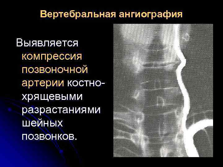 Вертебральная ангиография Выявляется компрессия позвоночной артерии костнохрящевыми разрастаниями шейных позвонков. 