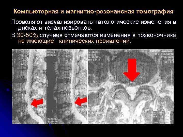 Компьютерная и магнитно-резонансная томография Позволяют визуализировать патологические изменения в дисках и телах позвонков. В