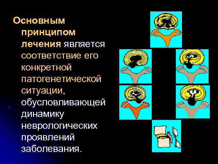 Основным принципом лечения является соответствие его конкретной патогенетической ситуации, обусловливающей динамику неврологических проявлений заболевания.