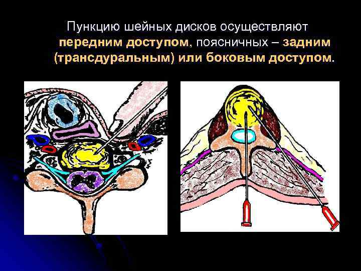 Пункцию шейных дисков осуществляют передним доступом, поясничных – задним (трансдуральным) или боковым доступом. 