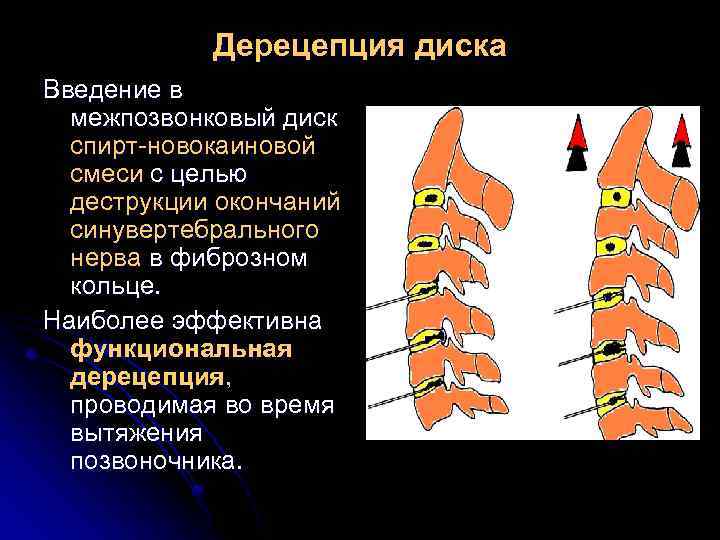 Дерецепция диска Введение в межпозвонковый диск спирт-новокаиновой смеси с целью деструкции окончаний синувертебрального нерва