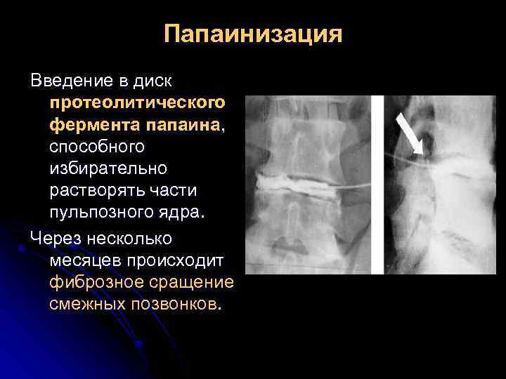 Папаинизация Введение в диск протеолитического фермента папаина, способного избирательно растворять части пульпозного ядра. Через