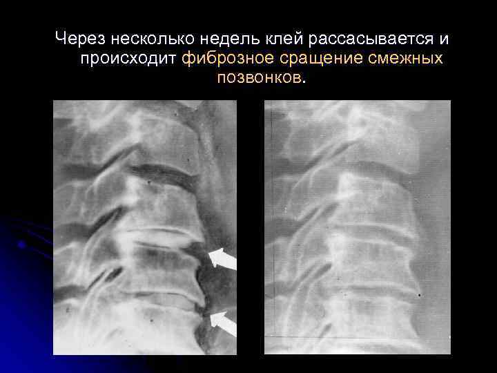 Через несколько недель клей рассасывается и происходит фиброзное сращение смежных позвонков. 