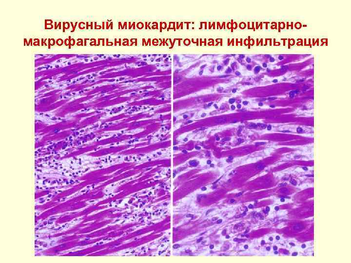 Вирусный миокардит: лимфоцитарномакрофагальная межуточная инфильтрация 