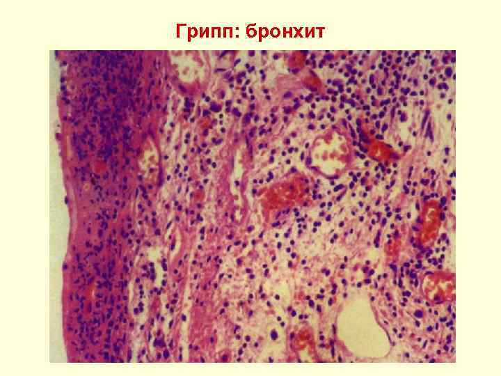Грипп: бронхит 