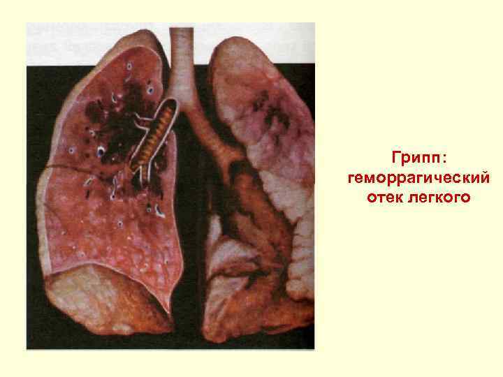 Грипп: геморрагический отек легкого 