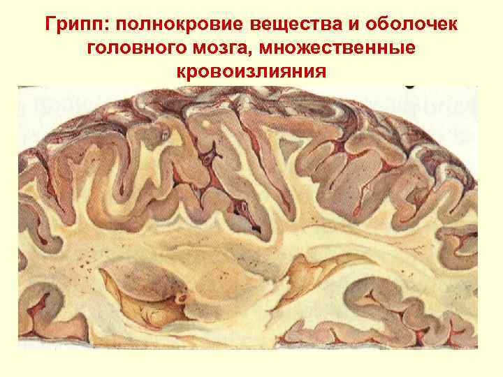 Грипп: полнокровие вещества и оболочек головного мозга, множественные кровоизлияния 