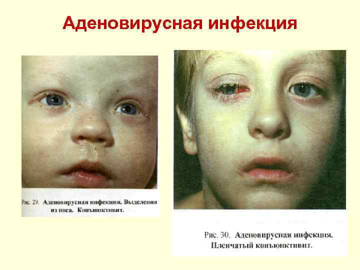 Аденовирусная инфекция 