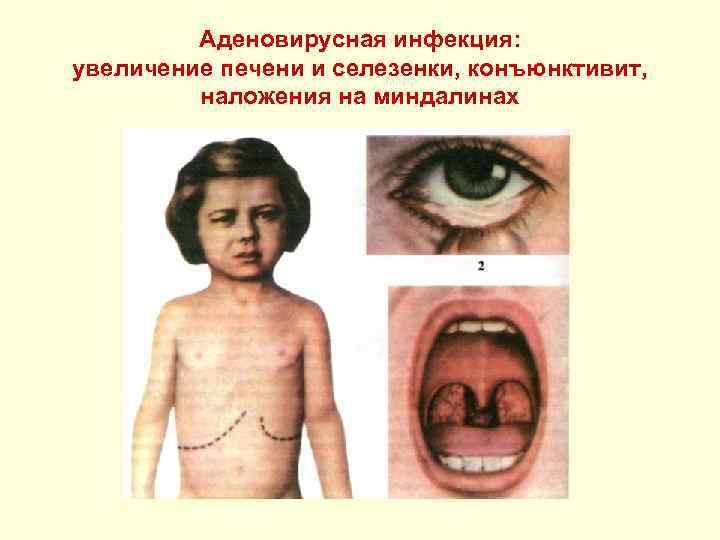 Аденовирусная инфекция: увеличение печени и селезенки, конъюнктивит, наложения на миндалинах 