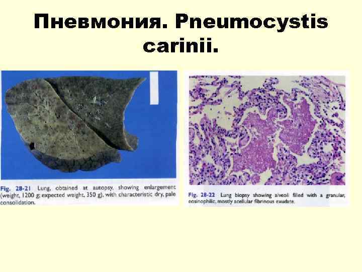 Пневмония. Pneumocystis carinii. 