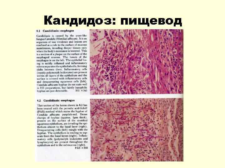 Кандидоз: пищевод 