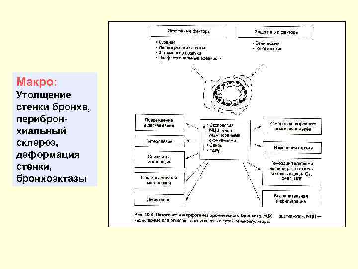 Макро: Утолщение стенки бронха, перибронхиальный склероз, деформация стенки, бронхоэктазы 