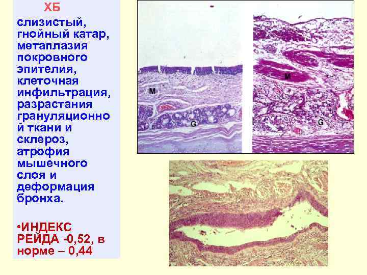 ХБ слизистый, гнойный катар, метаплазия покровного эпителия, клеточная инфильтрация, разрастания грануляционно й ткани и