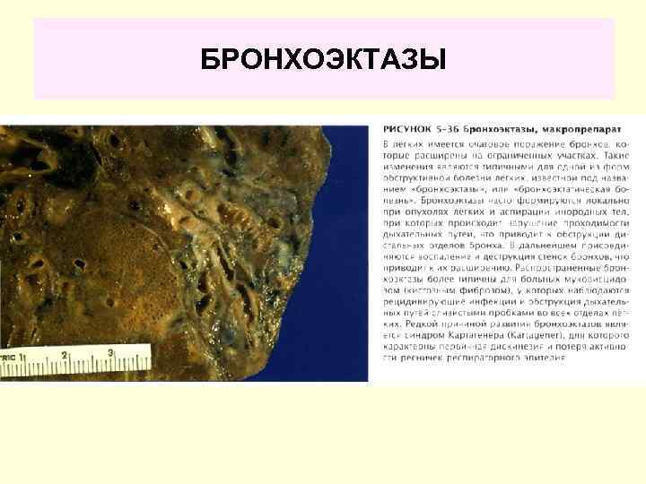 БРОНХОЭКТАЗЫ 
