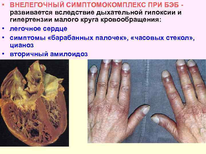  • ВНЕЛЕГОЧНЫЙ СИМПТОМОКОМПЛЕКС ПРИ БЭБ развивается вследствие дыхательной гипоксии и гипертензии малого круга