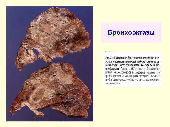 Бронхоэктазы 