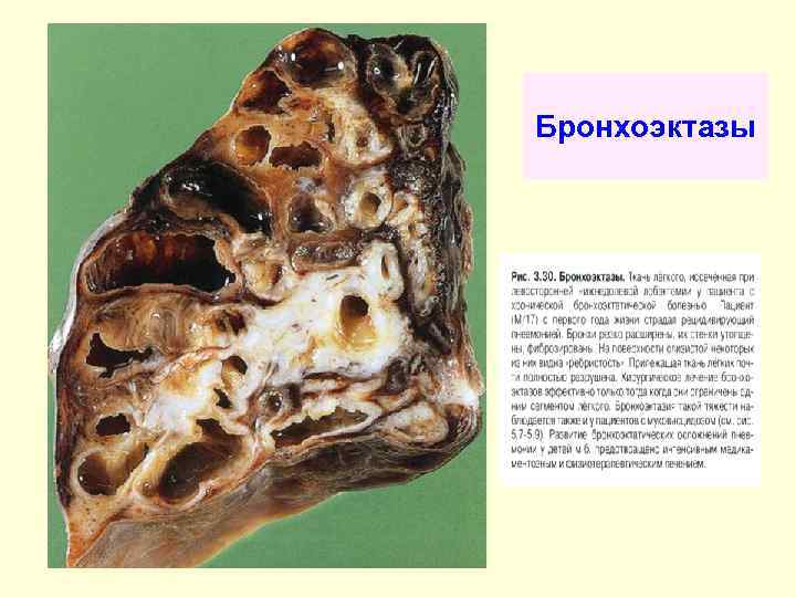 Бронхоэктазы 