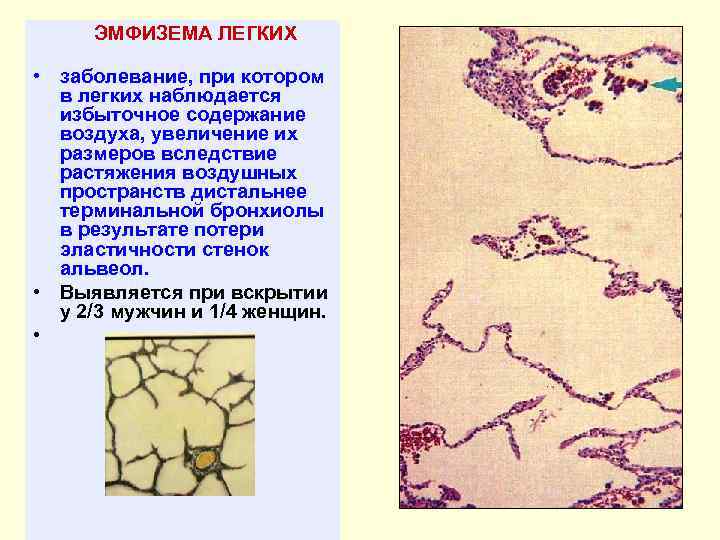 ЭМФИЗЕМА ЛЕГКИХ • заболевание, при котором в легких наблюдается избыточное содержание воздуха, увеличение их