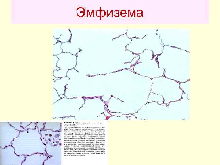 Эмфизема 