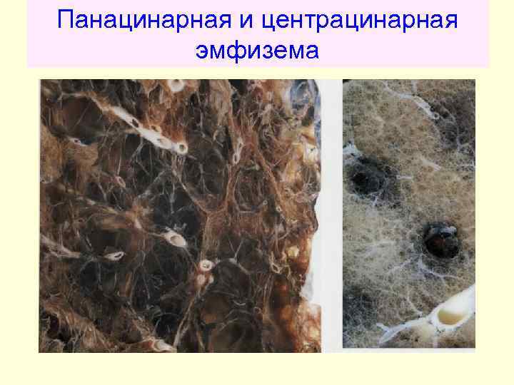 Панацинарная и центрацинарная эмфизема 