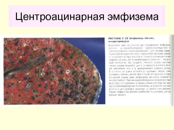 Центроацинарная эмфизема 