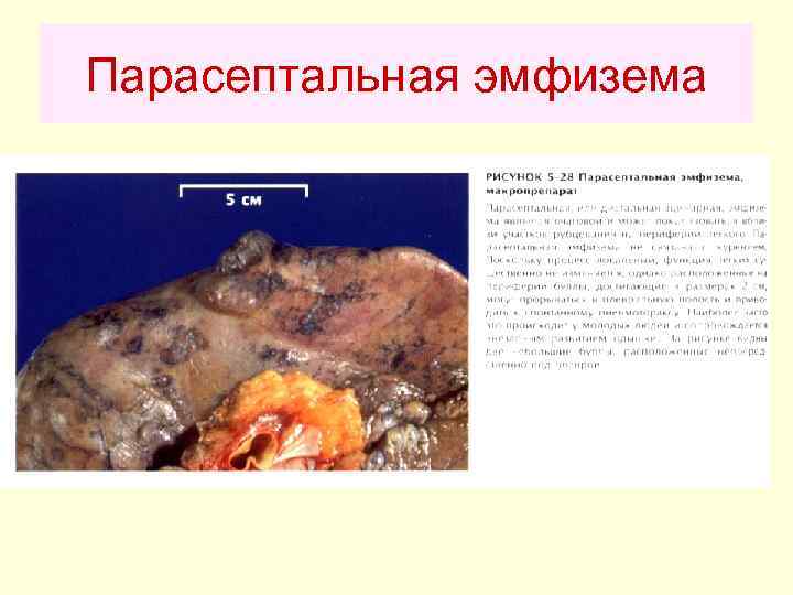 Парасептальная эмфизема 