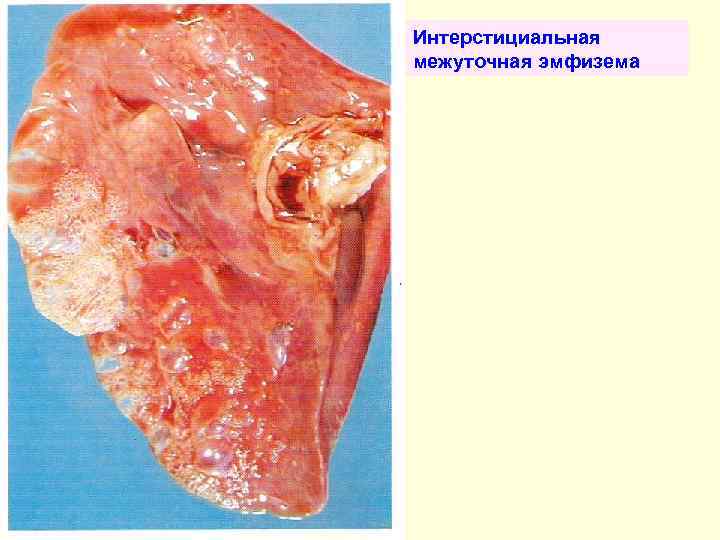 Интерстициальная межуточная эмфизема 