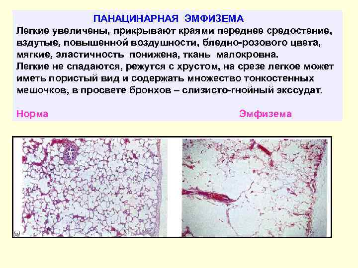 ПАНАЦИНАРНАЯ ЭМФИЗЕМА Легкие увеличены, прикрывают краями переднее средостение, вздутые, повышенной воздушности, бледно-розового цвета, мягкие,