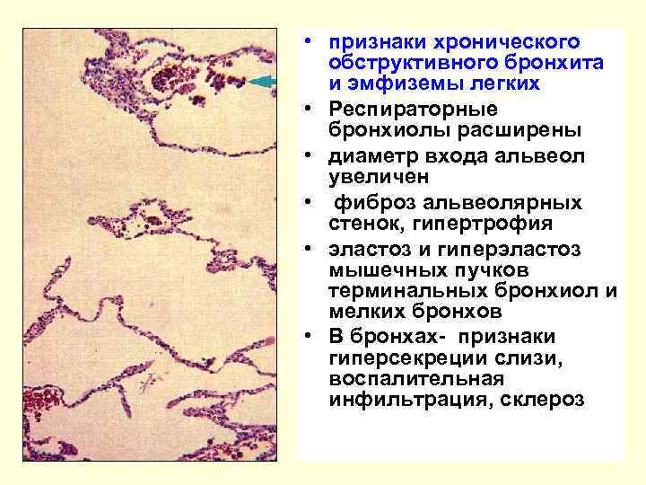  • признаки хронического обструктивного бронхита и эмфиземы легких • Респираторные бронхиолы расширены •
