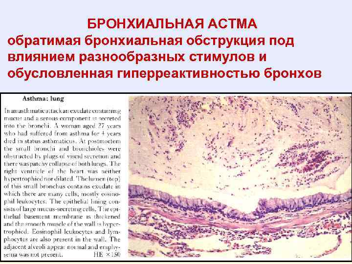 БРОНХИАЛЬНАЯ АСТМА обратимая бронхиальная обструкция под влиянием разнообразных стимулов и обусловленная гиперреактивностью бронхов 