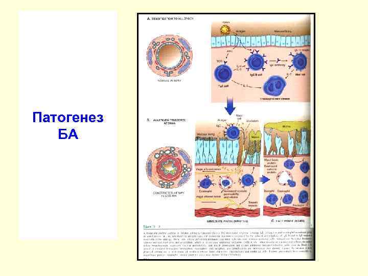 Патогенез БА 