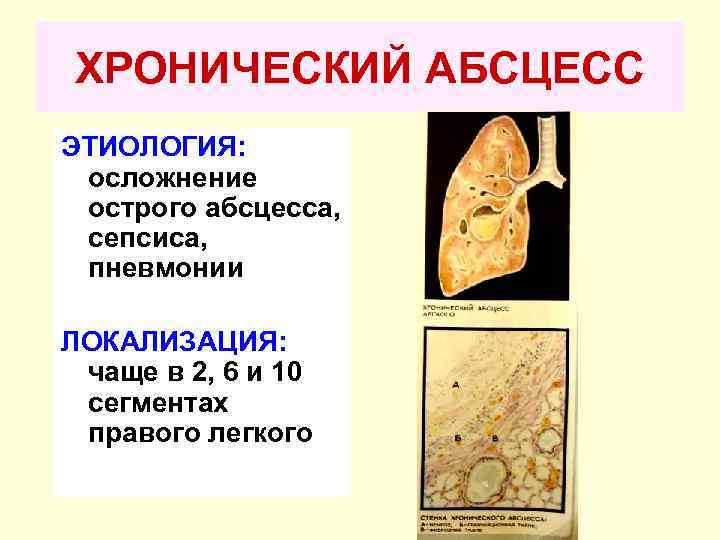 ХРОНИЧЕСКИЙ АБСЦЕСС ЭТИОЛОГИЯ: осложнение острого абсцесса, сепсиса, пневмонии ЛОКАЛИЗАЦИЯ: чаще в 2, 6 и