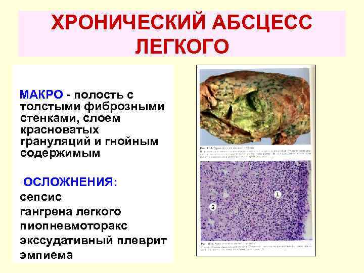 ХРОНИЧЕСКИЙ АБСЦЕСС ЛЕГКОГО МАКРО - полость с толстыми фиброзными стенками, слоем красноватых грануляций и