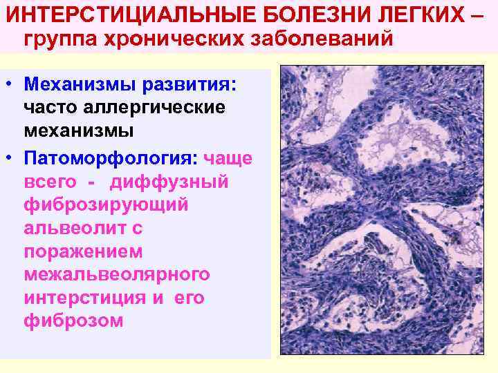 ИНТЕРСТИЦИАЛЬНЫЕ БОЛЕЗНИ ЛЕГКИХ – группа хронических заболеваний • Механизмы развития: часто аллергические механизмы •