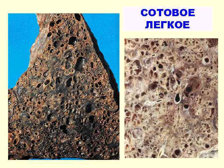 СОТОВОЕ ЛЕГКОЕ 