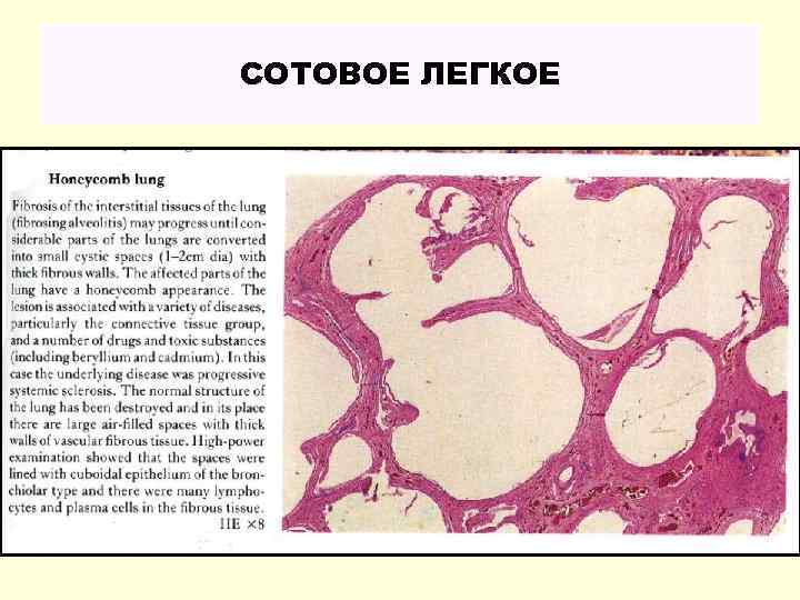СОТОВОЕ ЛЕГКОЕ 