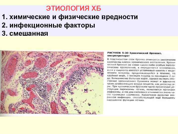 ЭТИОЛОГИЯ ХБ 1. химические и физические вредности 2. инфекционные факторы 3. смешанная 