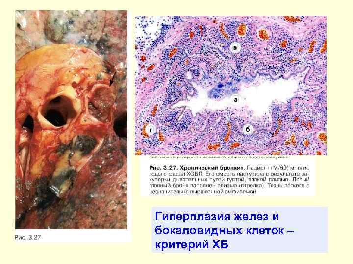 Гиперплазия желез и бокаловидных клеток – критерий ХБ 