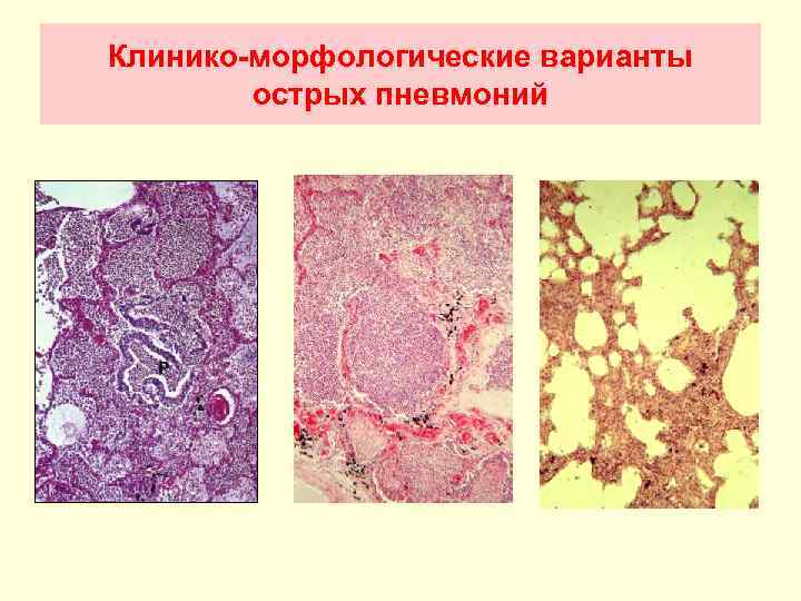 Клинико-морфологические варианты острых пневмоний 