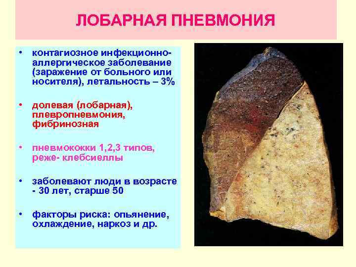 ЛОБАРНАЯ ПНЕВМОНИЯ • контагиозное инфекционноаллергическое заболевание (заражение от больного или носителя), летальность – 3%