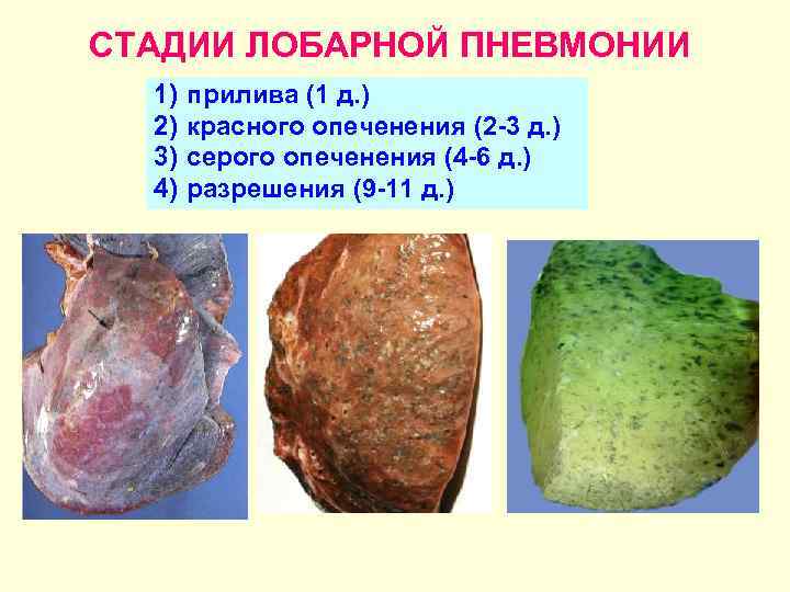 СТАДИИ ЛОБАРНОЙ ПНЕВМОНИИ 1) 2) 3) 4) прилива (1 д. ) красного опеченения (2