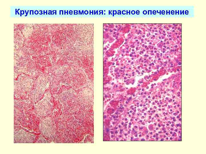 Крупозная пневмония: красное опеченение 
