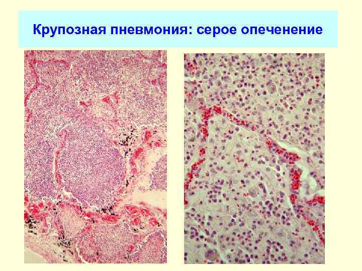 Крупозная пневмония рисунок